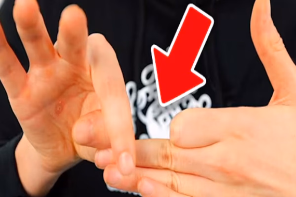 Infortunio shock: si stacca un dito