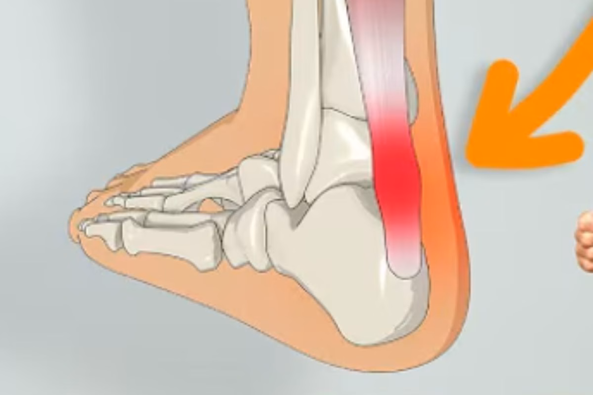 Tendine d'Achille ko